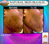 Natural Skin Bleaching Product That Works (Acne Scar Lightening, African American Skin Hyperpigmentation Spots)