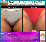 Natural Skin Bleaching Product That Works (Acne Scar Lightening, African American Skin Hyperpigmentation Spots)