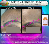 Natural Skin Bleaching Product That Works (Acne Scar Lightening, African American Skin Hyperpigmentation Spots)