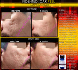 Indented Scar Removal Peel