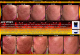 Indented Scar Removal Peel