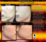 Treatment for Indented Scars Acne Chicken Pox Pitted Scar Removal Peel With Hyaluronic Acid - DevotedThings