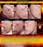 Indented Scar Removal Peel