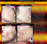 Indented Scar Removal Peel
