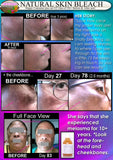 Natural Skin Bleaching Product That Works (Acne Scar Lightening, African American Skin, Hyperpigmentation Spots) - DevotedThings