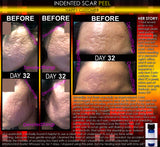 Indented Scar Removal Peel