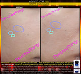 Indented Scar Removal Peel