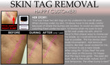 3 Day Peel For HPV Warts, Plantar Warts, Moles, Skin Tags, and Keloid Scars Removal Deepest Gentle Acid