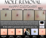 3 Day Peel For HPV Warts, Plantar Warts, Moles, Skin Tags, and Keloid Scars Removal Deepest Gentle Acid - DevotedThings