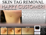 3 Day Peel For HPV Warts, Plantar Warts, Moles, Skin Tags, and Keloid Scars Removal Deepest Gentle Acid - DevotedThings