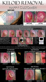 3 Day Peel For HPV Warts, Plantar Warts, Moles, Skin Tags, and Keloid Scars Removal Deepest Gentle Acid - DevotedThings