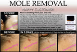 3 Day Peel For HPV Warts, Plantar Warts, Moles, Skin Tags, and Keloid Scars Removal Deepest Gentle Acid - DevotedThings