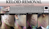 3 Day Peel For HPV Warts, Plantar Warts, Moles, Skin Tags, and Keloid Scars Removal Deepest Gentle Acid - DevotedThings