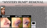 3 Day Peel For HPV Warts, Plantar Warts, Moles, Skin Tags, and Keloid Scars Removal Deepest Gentle Acid - DevotedThings