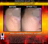 Treatment for Indented Scars Acne Chicken Pox Pitted Scar Removal Peel With Hyaluronic Acid - DevotedThings
