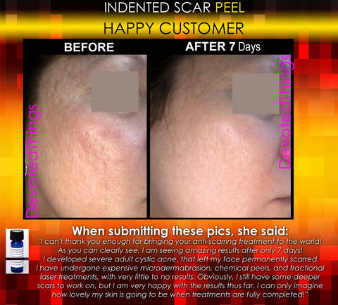 Treatment for Indented Scars Acne Chicken Pox Pitted Scar Removal Peel With Hyaluronic Acid - DevotedThings