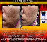 Treatment for Indented Scars Acne Chicken Pox Pitted Scar Removal Peel With Hyaluronic Acid - DevotedThings