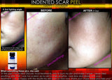 Treatment for Indented Scars Acne Chicken Pox Pitted Scar Removal Peel With Hyaluronic Acid - DevotedThings