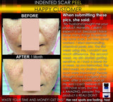 Treatment for Indented Scars Acne Chicken Pox Pitted Scar Removal Peel With Hyaluronic Acid - DevotedThings