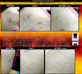 Treatment for Indented Scars Acne Chicken Pox Pitted Scar Removal Peel With Hyaluronic Acid - DevotedThings
