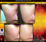 Treatment for Indented Scars Acne Chicken Pox Pitted Scar Removal Peel With Hyaluronic Acid - DevotedThings