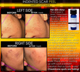 Treatment for Indented Scars Acne Chicken Pox Pitted Scar Removal Peel With Hyaluronic Acid - DevotedThings