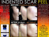 Treatment for Indented Scars Acne Chicken Pox Pitted Scar Removal Peel With Hyaluronic Acid - DevotedThings