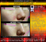 Treatment for Indented Scars Acne Chicken Pox Pitted Scar Removal Peel With Hyaluronic Acid - DevotedThings