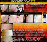 Treatment for Indented Scars Acne Chicken Pox Pitted Scar Removal Peel With Hyaluronic Acid - DevotedThings