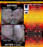 Treatment for Indented Scars Acne Chicken Pox Pitted Scar Removal Peel With Hyaluronic Acid - DevotedThings