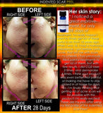 Treatment for Indented Scars Acne Chicken Pox Pitted Scar Removal Peel With Hyaluronic Acid - DevotedThings