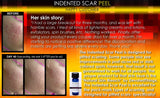 Treatment for Indented Scars Acne Chicken Pox Pitted Scar Removal Peel With Hyaluronic Acid - DevotedThings