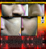 Treatment for Indented Scars Acne Chicken Pox Pitted Scar Removal Peel With Hyaluronic Acid - DevotedThings