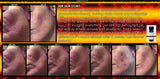 Treatment for Indented Scars Acne Chicken Pox Pitted Scar Removal Peel With Hyaluronic Acid - DevotedThings