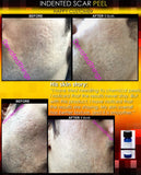 Treatment for Indented Scars Acne Chicken Pox Pitted Scar Removal Peel With Hyaluronic Acid - DevotedThings