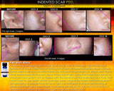 Treatment for Indented Scars Acne Chicken Pox Pitted Scar Removal Peel With Hyaluronic Acid - DevotedThings