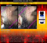 Treatment for Indented Scars Acne Chicken Pox Pitted Scar Removal Peel With Hyaluronic Acid - DevotedThings