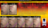 Treatment for Indented Scars Acne Chicken Pox Pitted Scar Removal Peel With Hyaluronic Acid - DevotedThings