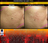 Treatment for Indented Scars Acne Chicken Pox Pitted Scar Removal Peel With Hyaluronic Acid - DevotedThings
