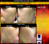 Treatment for Indented Scars Acne Chicken Pox Pitted Scar Removal Peel With Hyaluronic Acid - DevotedThings