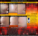 Treatment for Indented Scars Acne Chicken Pox Pitted Scar Removal Peel With Hyaluronic Acid - DevotedThings