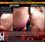Treatment for Indented Scars Acne Chicken Pox Pitted Scar Removal Peel With Hyaluronic Acid - DevotedThings