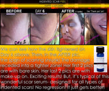 Treatment for Indented Scars Acne Chicken Pox Pitted Scar Removal Peel With Hyaluronic Acid - DevotedThings