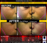 Treatment for Indented Scars Acne Chicken Pox Pitted Scar Removal Peel With Hyaluronic Acid - DevotedThings