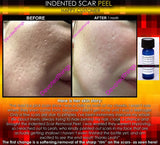 Treatment for Indented Scars Acne Chicken Pox Pitted Scar Removal Peel With Hyaluronic Acid - DevotedThings