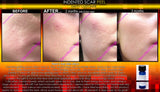 Treatment for Indented Scars Acne Chicken Pox Pitted Scar Removal Peel With Hyaluronic Acid - DevotedThings