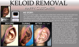 Bump Removal 3-Day Peel
