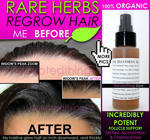 Organic Herbal Hair Loss Treatment, Hair Regrowth Support, and Anti  Dandruff Spray