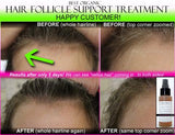 Organic Herbal Hair Loss Treatment, Hair Regrowth Support, and Anti Dandruff Spray - DevotedThings