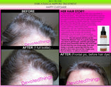 Organic Herbal Hair Loss Treatment, Hair Regrowth Support, and Anti Dandruff Spray - DevotedThings